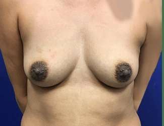 Breast Augmentation Before & After Patient #2080