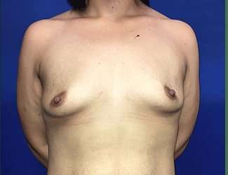 Breast Augmentation Before & After Patient #2091