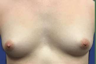 Breast Augmentation Before & After Patient #2102