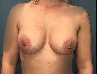 Breast Augmentation Before & After Patient #2122