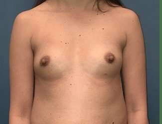 Breast Augmentation Before & After Patient #2133
