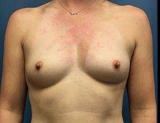 Breast Augmentation Before & After Patient #2191