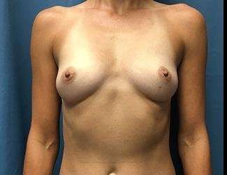 Breast Augmentation Before & After Patient #2202