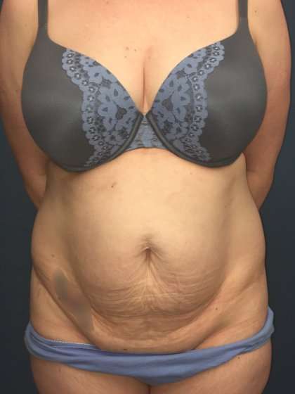Tummy Tuck Before & After Patient #428