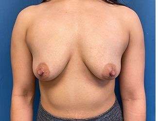 Breast Augmentation Before & After Patient #2213