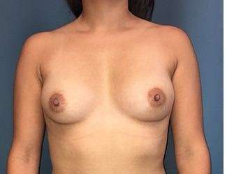 Breast Augmentation Before & After Patient #2242