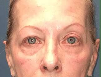 Blepharoplasty Before & After Patient #2271