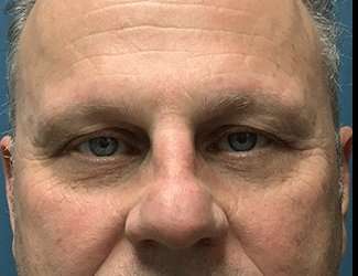 Blepharoplasty Before & After Patient #2282