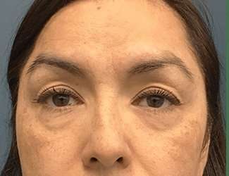 Blepharoplasty Before & After Patient #2293