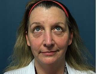 Blepharoplasty Before & After Patient #2308