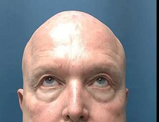 Blepharoplasty Before & After Patient #2328