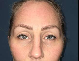 Blepharoplasty Before & After Patient #2339