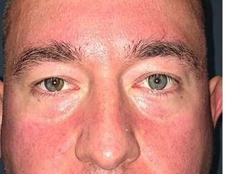 Blepharoplasty Before & After Patient #2352