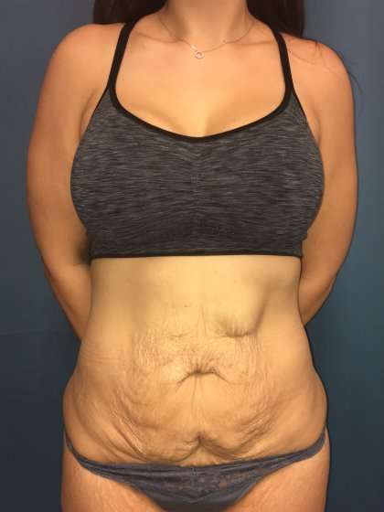 Tummy Tuck Before & After Patient #439