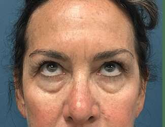 Blepharoplasty Before & After Patient #2368