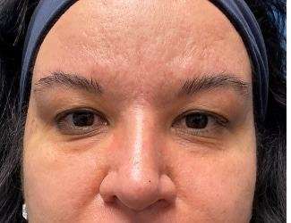 Blepharoplasty Before & After Patient #2385