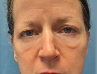 Blepharoplasty Before & After Patient #2408