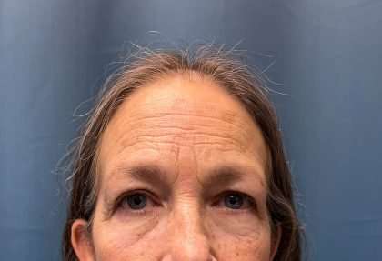Blepharoplasty Before & After Patient #2419
