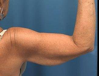 Arm Lift Before & After Patient #2461