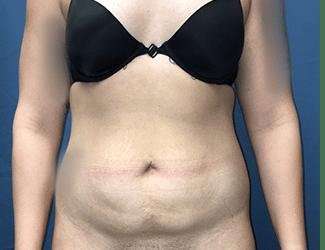 Tummy Tuck Before & After Patient #457