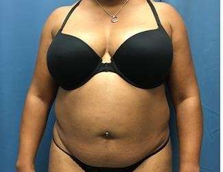 Tummy Tuck Before & After Patient #468