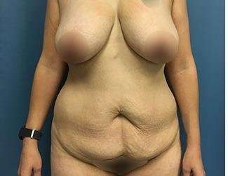 Tummy Tuck Before & After Patient #493