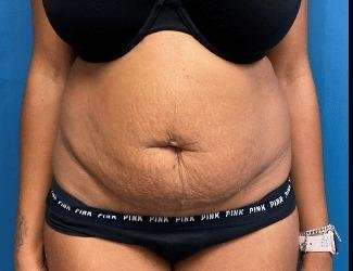 Tummy Tuck Before & After Patient #504