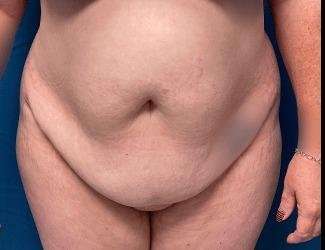 Tummy Tuck Before & After Patient #515