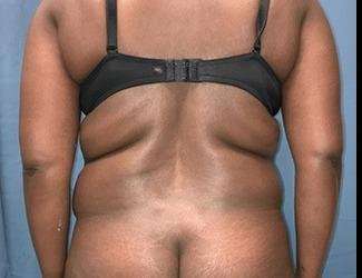 Tummy Tuck Before & After Patient #528