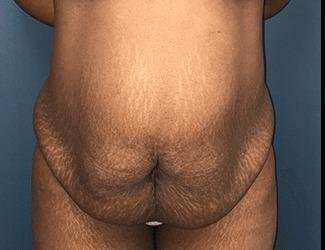 Tummy Tuck Before & After Patient #546