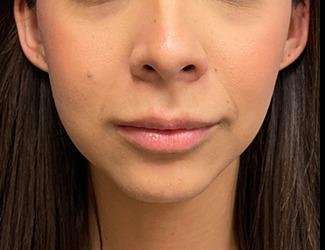 Submentoplasty Before & After Patient #632
