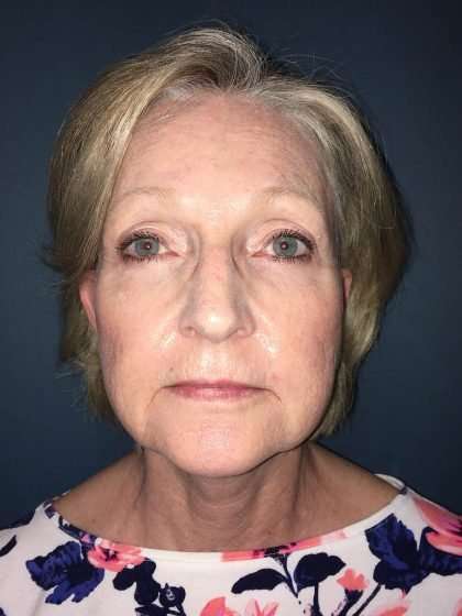 Submentoplasty Before & After Patient #654