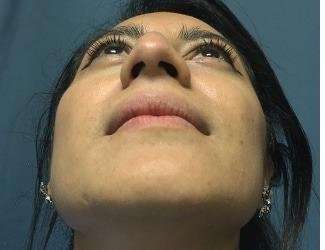 Rhinoplasty Before & After Patient #667
