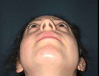 Rhinoplasty Before & After Patient #680