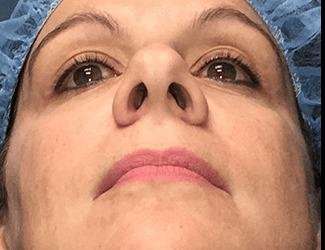 Rhinoplasty Before & After Patient #693