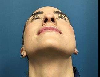 Rhinoplasty Before & After Patient #706
