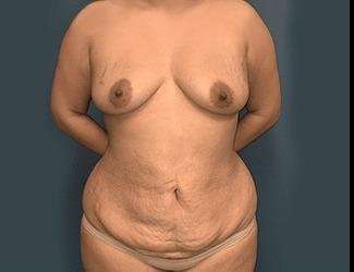 Mommy Makeover Before & After Patient #743