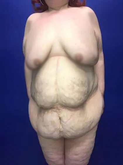 Mommy Makeover Before & After Patient #893