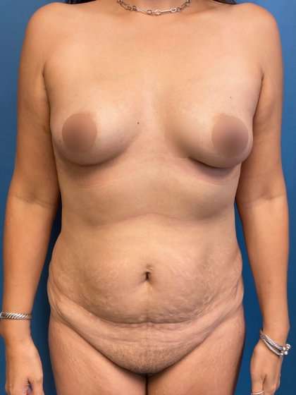Mommy Makeover Before & After Patient #944