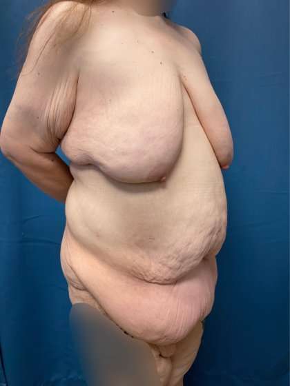 Lower Body Lift Before & After Patient #1021