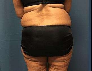 Lower Body Lift Before & After Patient #1047