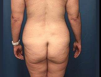 Lower Body Lift Before & After Patient #1114