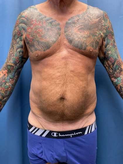 Tummy Tuck Before & After Patient #322