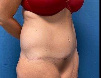 Lower Body Lift Before & After Patient #1127