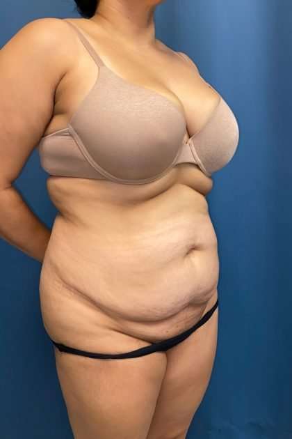 Lower Body Lift Before & After Patient #1213