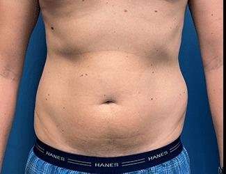 Liposuction Before & After Patient #1257