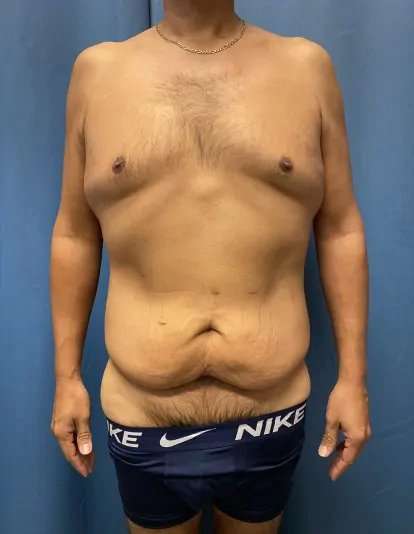 Tummy Tuck Before & After Patient #333