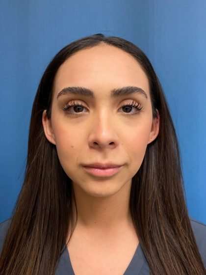 Lip Lift Before & After Patient #1279
