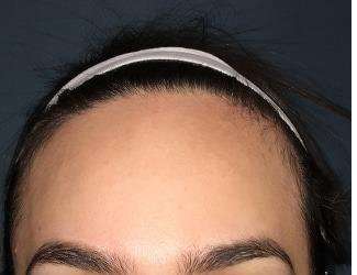 Forehead Reduction Before & After Patient #1364
