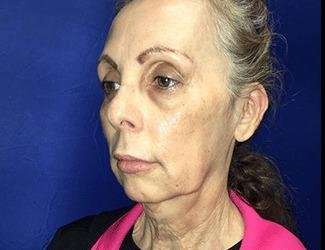 Facial Implants Before & After Patient #1392